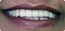 6 unit anterior PFM Bridge